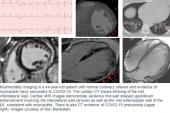 Which Modality and When? New Guidance for Cardiac Imaging in COVID-19 